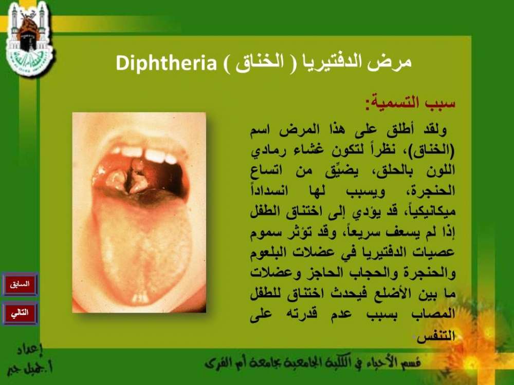 وفاة الحالة الثانية في اليمن بسبب مرض وباء الدفتيريا " الخناق " Diphtheria