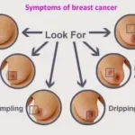 اعراض سرطان الثدي افرازات حلمة الثدي