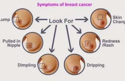 اعراض سرطان الثدي افرازات حلمة الثدي