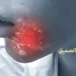 ماهو مرض الصميق وماهي أسباب مرض الصميق وأعراضه وعلاجه