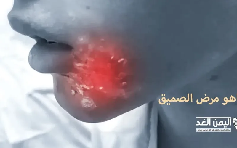 ماهو مرض أبو الصميق