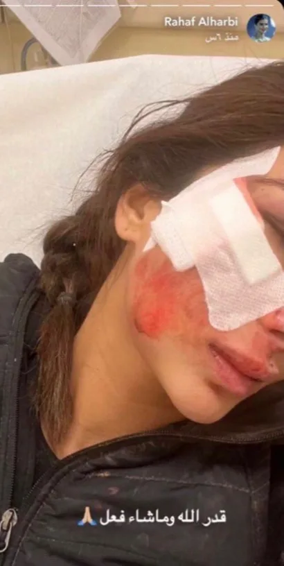 الإصابات اللي تعرضت لها رهف الحربي