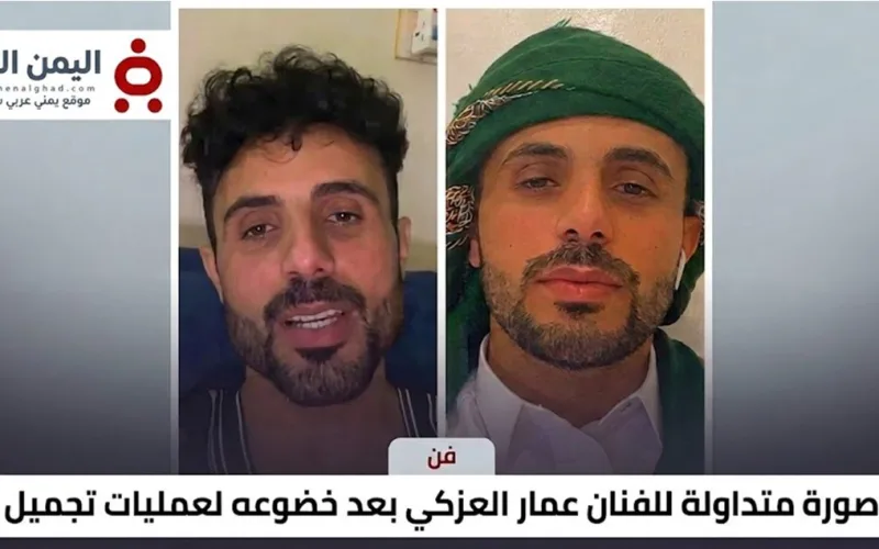 صدمة وتفاعل واسع.. ملامح جديدة للفنان عمار العزكي بعد خضوعه لعملية تجميل (صورة)