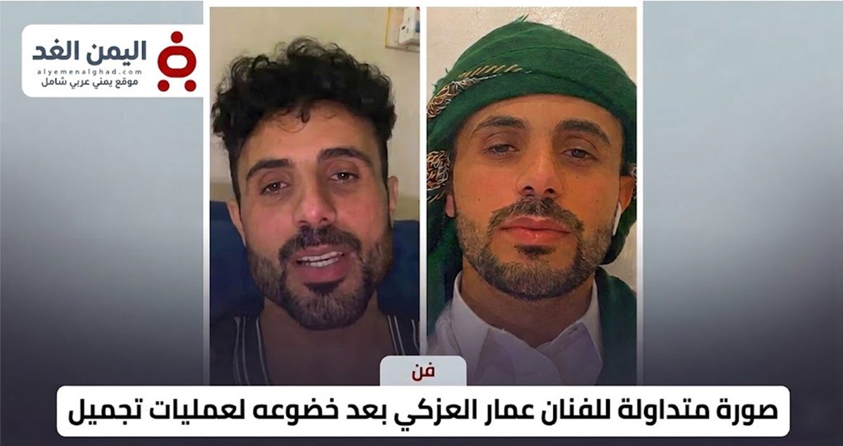 صدمة وتفاعل واسع.. ملامح جديدة للفنان عمار العزكي بعد خضوعه لعملية تجميل (صورة) Ammar Al-Azki after cosmetic surgery