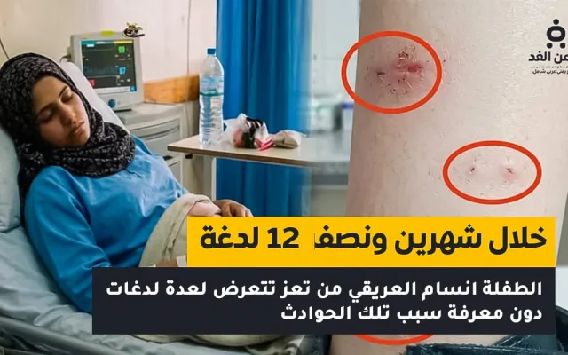 طفلة تتعرض لاكثر من 11 لدغة من ثعابين تعرف على تفاصيل قصة أنسام العريقي