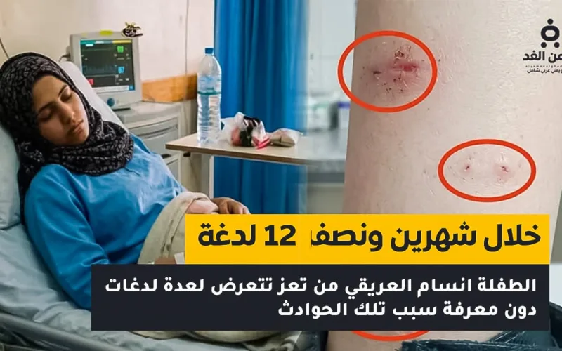 طفلة تتعرض لاكثر من 11 لدغة من ثعابين تعرف على تفاصيل قصة أنسام العريقي
