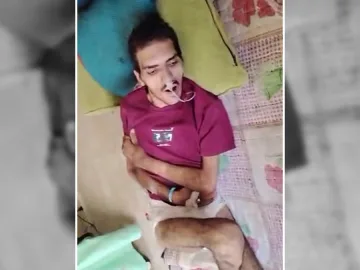 معيد في جامعة صنعاء يفقد الحركة
